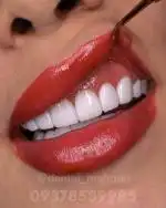  کامپوزیت دندان ایمپلنت لمینت عصب کشی کلینیک ماهانا