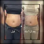 لاغری بدون جراحی با کرایولیپولیز