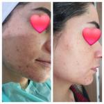 پاکسازی تخصصی و درمانی پوست با بهترین برند وارداتی توسط متصدی حرفه ای